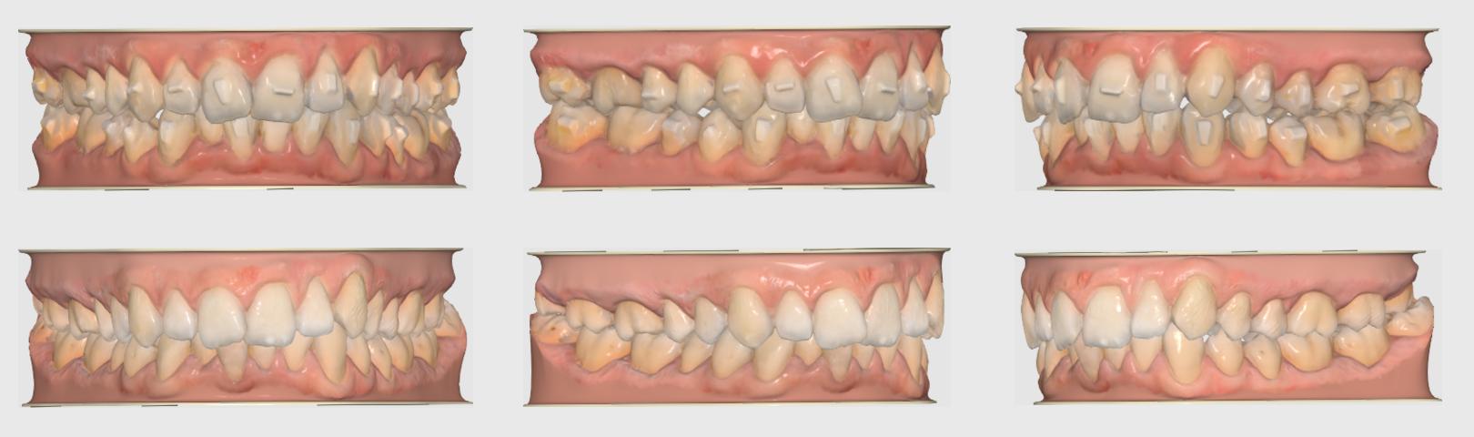Mid-Treatment Scan