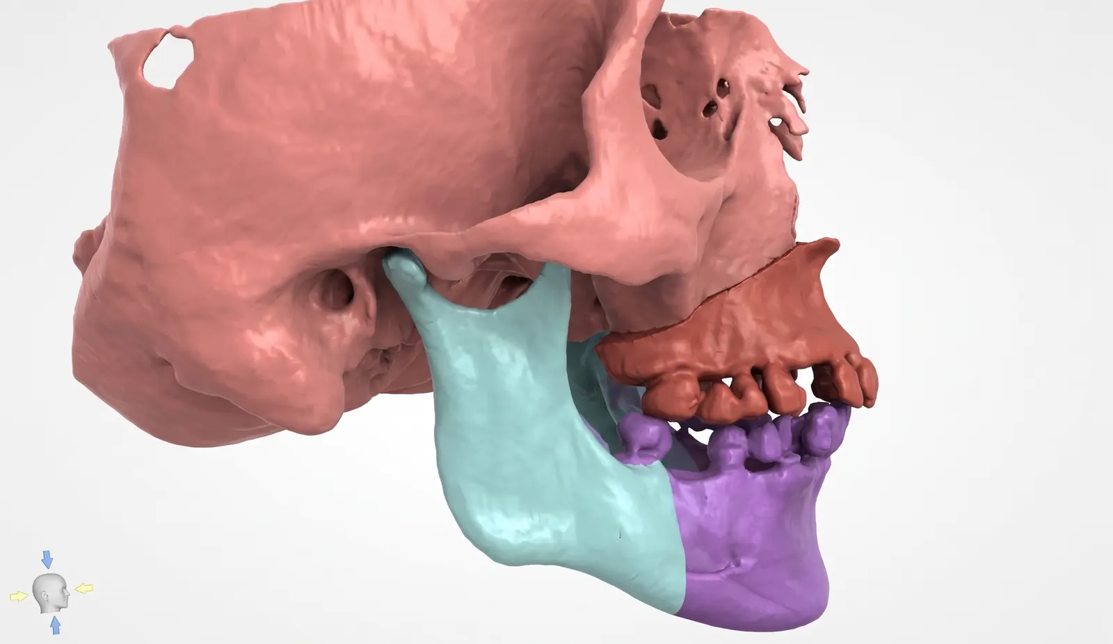 Maxillofacial Surgical Guides Dentsplan