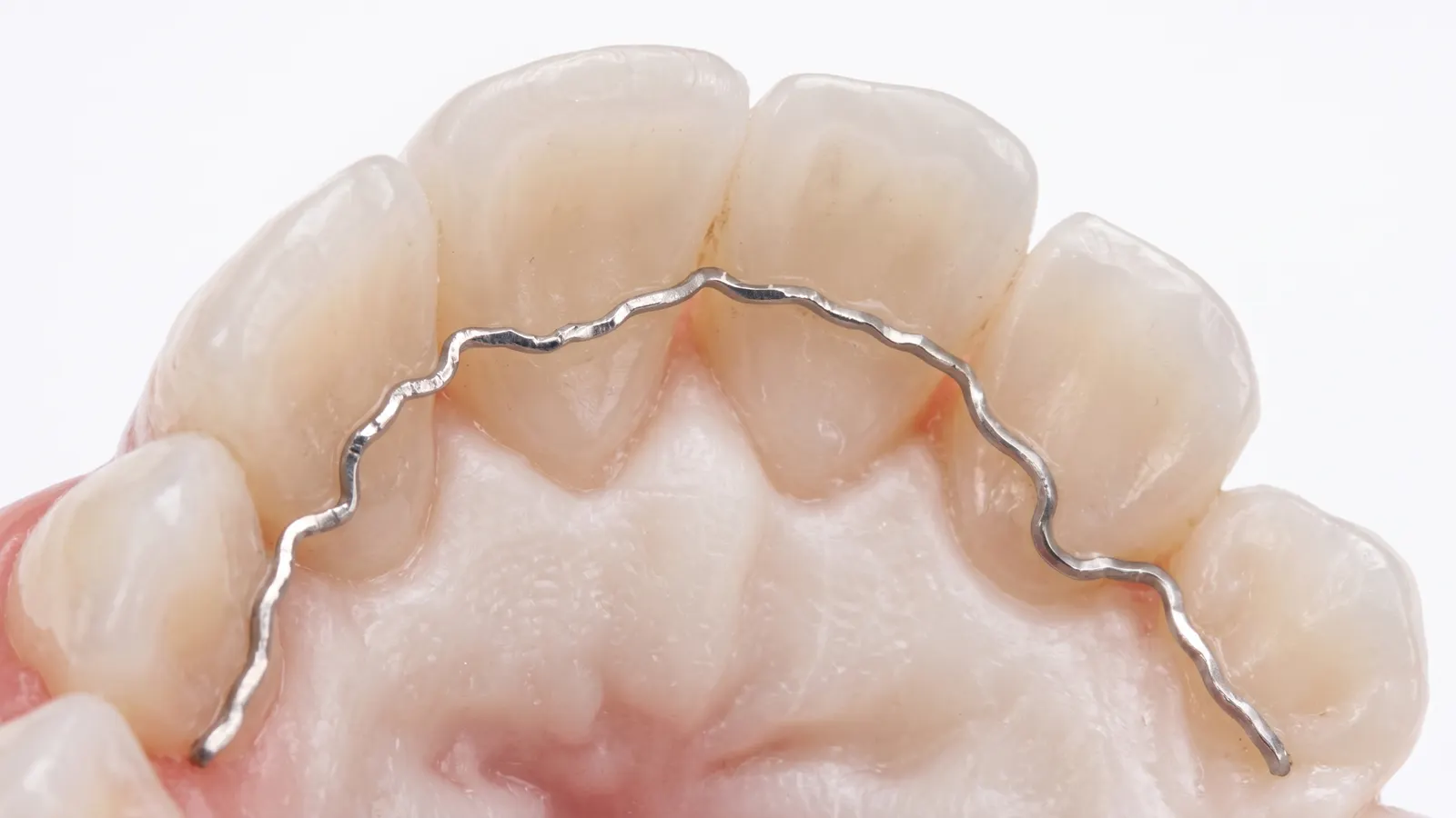 Retainers Dentsplan